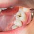 ترمیم پوسیدگی دندان و جلوگیری از پیشرفت پوسیدگی دندان